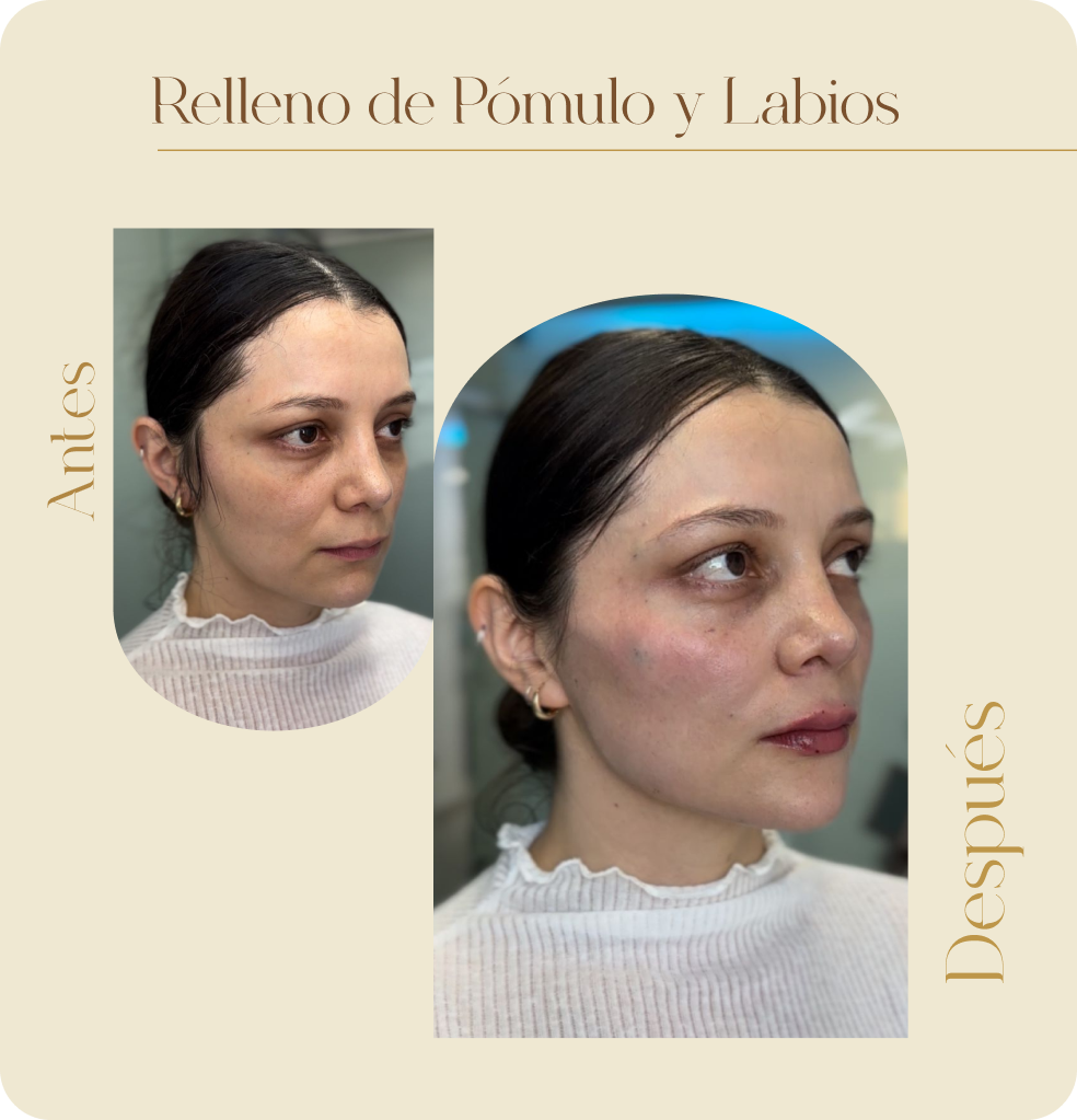 ImgAmortizacionFacial07